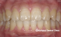 空隙歯列(すきっ歯)の矯正実例(治療後)