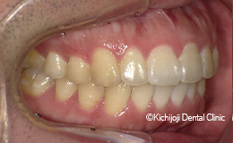 上顎前突(出っ歯)の矯正実例(治療後)