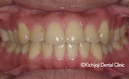 大きい前歯の矯正実例(治療後)