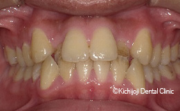 大きい前歯の矯正実例(治療前)