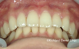 矯正治療後の後戻りの矯正実例(治療後)