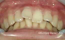 矯正治療後の後戻りの矯正実例(治療前)