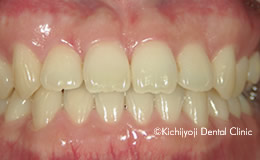 その他の矯正実例(治療後)