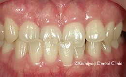 その他の矯正実例(治療前)