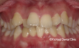 叢生(デコボコ)の矯正実例(治療前)