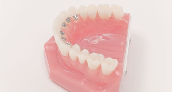 裏側矯正(舌側矯正)