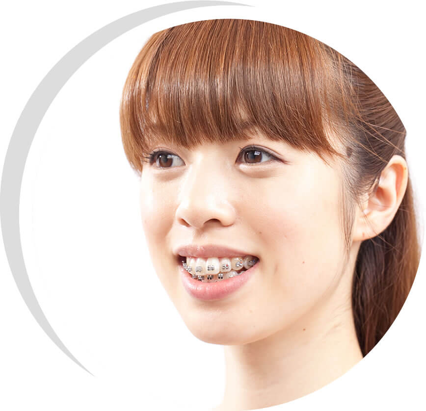 表側矯正をしている女性 表側矯正をしている女性
