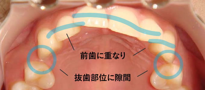 矯正後に後戻りした例